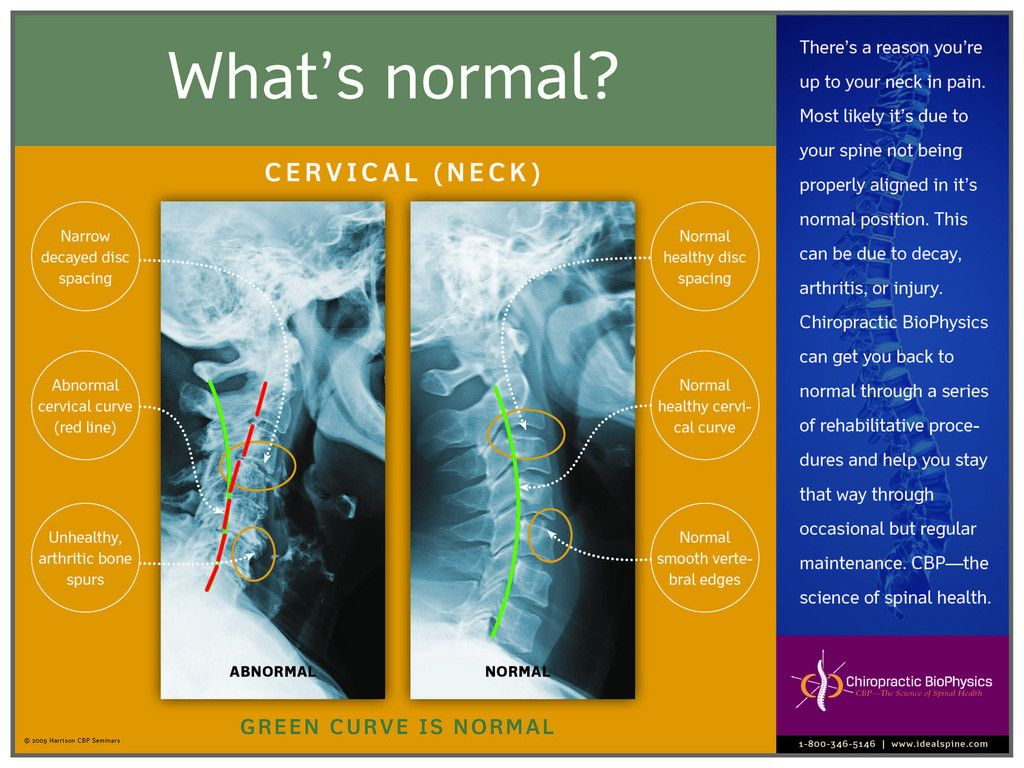 Normal Vs. Abnormal Cervical X Ray – Chiropractic Biophysics Regarding Chiropractic X Ray Report Template