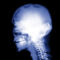 Skull Implants X Ray Backgrounds For Powerpoint – Health And Within Radiology Powerpoint Template